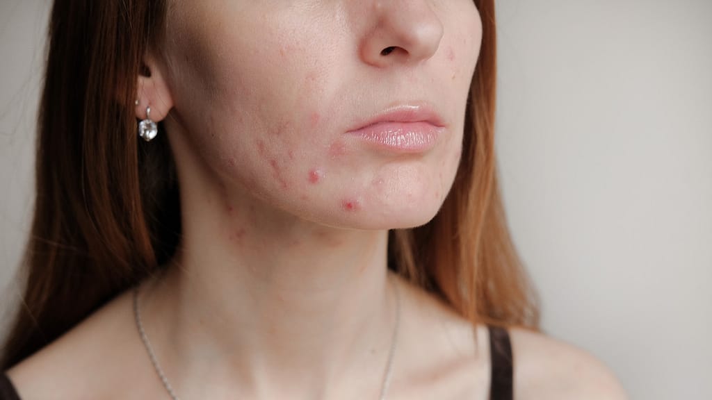 maskne acne da mascherina