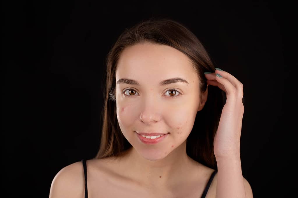 ragazza con comedoni sul viso