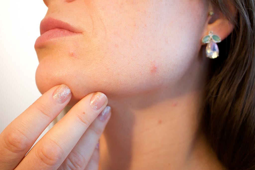 Sintomi dell’acne e fattori scatenanti: le soluzioni disponibili!