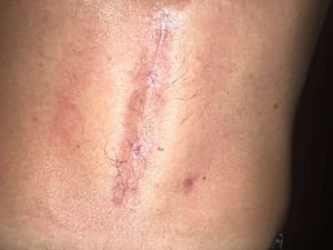 Cicatrice post operatoria