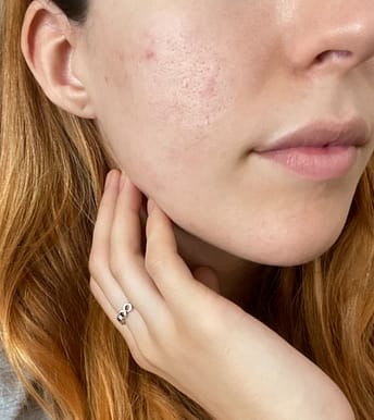 opinione q acne complex