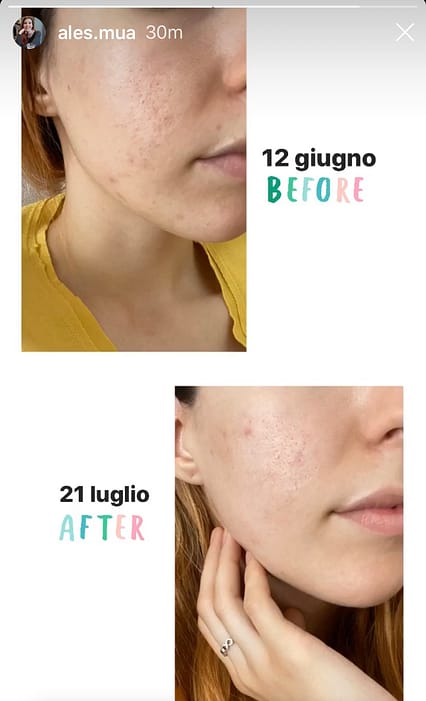 testimonianza q acne complex
