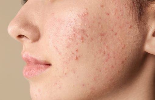 acne sul viso di una giovane ragazza