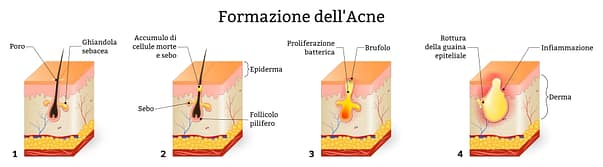 Acne formazione