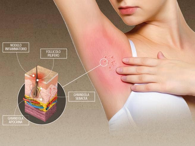 Brufolo sotto l’ascella: cause, rimedi e prevenzione Q-Acne Complex