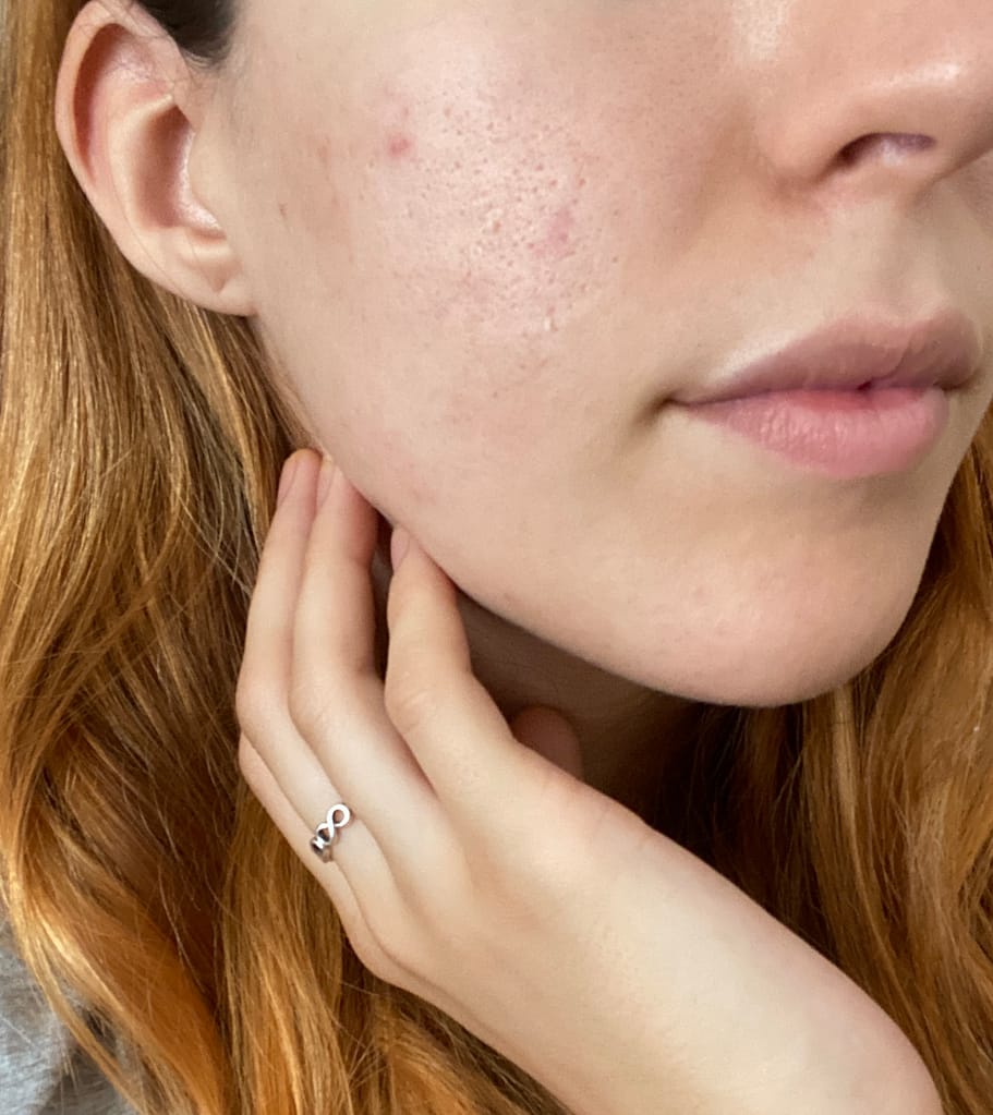 Il “prima e dopo” Acne Complex di Alessandra!