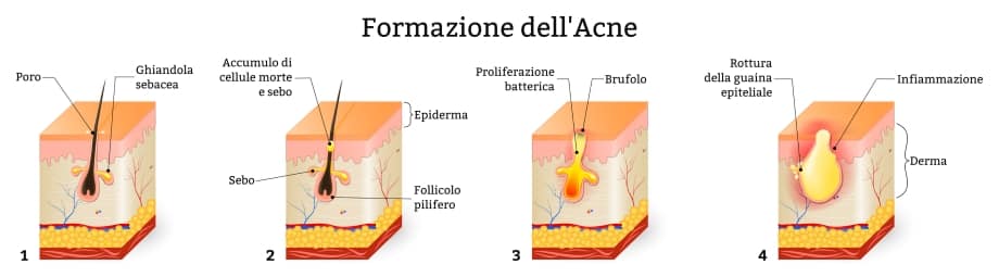 brufolo sotto l’ascella formazione